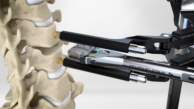 Video thumbnail: prodisc C Vivo Surgical Animation (2-Level)