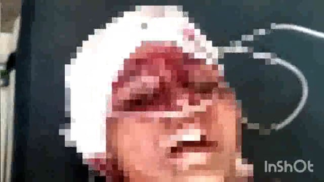 सुगौली के भटवलिया में दो किशोरियों के बीच हुई विवाद में एक ने दूसरे को खुरपी से काट किया गंभीर।