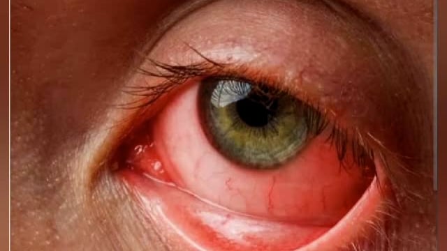 आंख में ऐसा लक्ष्ण दिखे तो घबराने की जरूरत नहीं, सावधानी बरतने की है जरूरत