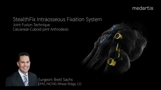 LIT-1663 StealthFix (Lateral)
