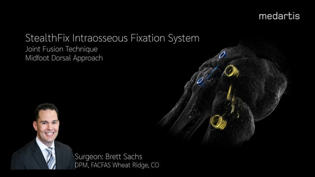 LIT-1662 StealthFix Cadaver Video (Dorsal)