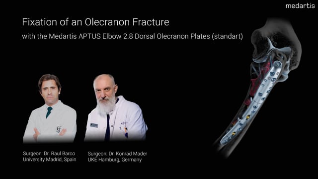 Fixation of an Olecranon Fracture with the APTUS Dorsal Olecranon Plate 2.8 (standard)