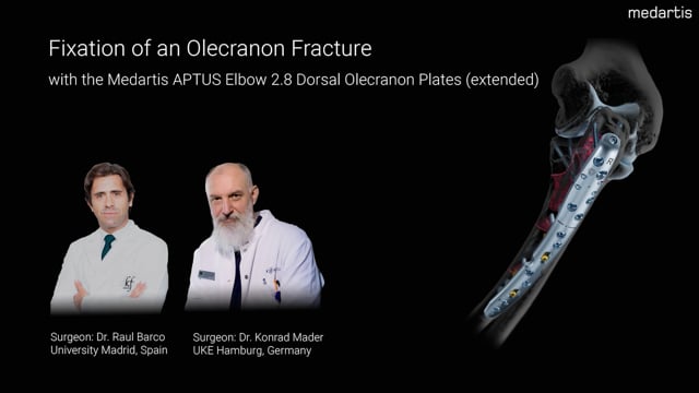 Fixation of an Olecranon Fracture with the APTUS Dorsal Olecranon Plate 2.8 (extended)